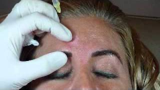 Glabellar Botox Injection Technique  Botox Class [upl. by Chelsea971]