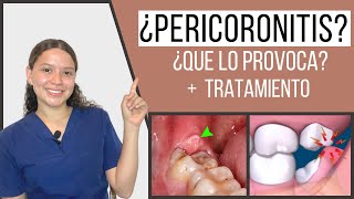 Pericoronitis  Pericoronaritis  Qué es y tratamiento  Odontología Con Cri [upl. by Lairret]