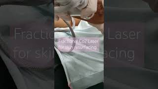 Fractional Co2 laser Treatment [upl. by Toffey]