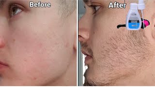 minoxidil beard growth  3 month transformation  mintop minoxidil review  derma roller for beard [upl. by Rafaelle]