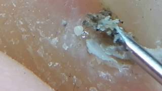 How to clean in depth lateral toenail fold 7 After beach [upl. by Atsev]