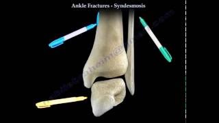 Ankle Fractures and the Syndesmosis  Everything You Need To Know  Dr Nabil Ebraheim [upl. by Jacie906]