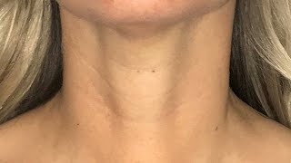 Scarless Thyroidectomy  Transoral Endoscopic Thyroidectomy Vestibular Approach [upl. by Anayrb874]