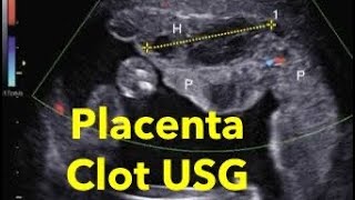 Placental clot and placental lakes ultrasound  color doppler [upl. by Orman599]