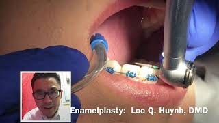 How to do enamelplasty [upl. by Sydney]