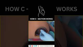 Cesarean Section Explained Why Doctors Choose CSections for a Safer Birth 👶✂️ Cesarean Birth [upl. by Enomed]