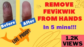 how to remove fevikwik from finger  feviquick hath se kaise nikale  Remove super glue from skin [upl. by Caprice]