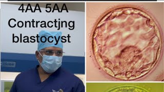 Ivf ICSIblastocyst 4AA expanded blast 5AA hatching blastocyst poor blastocyst embryo biopsyivf [upl. by Dirrej]