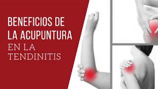 Beneficios de la Acupuntura en la Tendinitis [upl. by Duster]