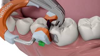 Systèmes de Matrices Sectionnelles Composi Tight® 3D Fusion™ [upl. by Yrellam]