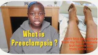 What is Preeclampsia My Story [upl. by Elehcir141]