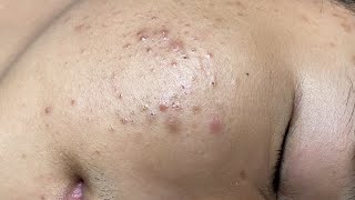 ACNE TREATMENT VU QUYNH MI  Perennial Blackheads On Boy Face 2024FULL [upl. by Aeirdna764]