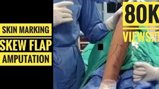 Skew Flap for Below Knee Amputation Skin Marking for perfect Stump [upl. by Innek]