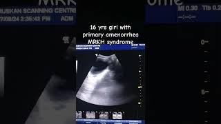 uterineagenesis MRKHsynrome primaryamenorrhea ultrasoundscans menarche [upl. by Nowell]