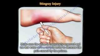 Stingray fish injury  Everything You Need To Know  Dr Nabil Ebraheim [upl. by Hausner593]