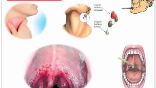 Streptococcus Pyogenes [upl. by Eiznekcam326]