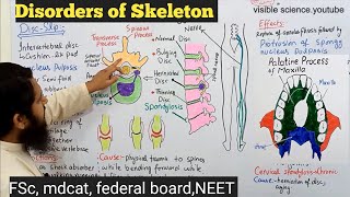 deformities of skeleton class 12  disorders of human skeleton class 12 [upl. by Nwad]