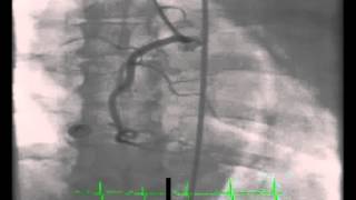 Right Coronary Artery Angiogram [upl. by Fayina]