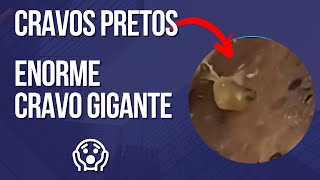 Cravos pretos profundos e gigantes RETIRANDO CRAVOS MUITO PRETOS Vídeos satisfatório e relaxante 2 [upl. by Ellehsar]