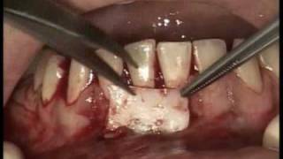 Implants Dentaires  Greffe gingivale libre [upl. by Nerissa379]