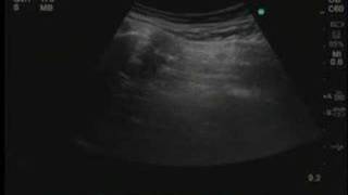 UltrasoundGuided Piriformis Muscle Injection [upl. by Folberth143]