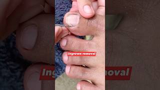 Toenail cleaning pedicure nails dryskin ingrown satisfying satisfyingvideo ytshorts fypage [upl. by Dnomasor]