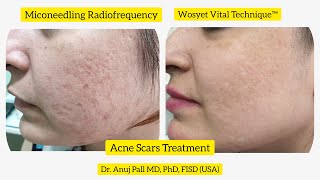 Acne scars treatment with Microneedling Radiofrequency  Subcision  Wosyet Vital Technique™ [upl. by Henri]