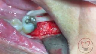 Delayed Implant Placement for Mandibular Molar 19 [upl. by Tioneb]