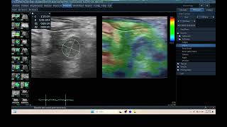 IQ 309 MESENTARY LN ENLARGEMENT ASCITES BLOOD LYMPHOMA ULTRASOUND ELASTOGRAPHY [upl. by Eleazar]