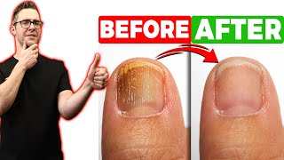 BEST Toenail Fungus Treatment 2024 4 BIG SECRETS [upl. by Martelli676]