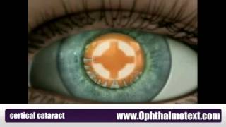 Cortical cataract [upl. by Lucila492]