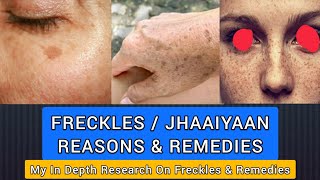 Freckles  ज्ञाइयां  What Why Types Home remedies Other Treatments  With English Subtitles [upl. by Mirabelle880]