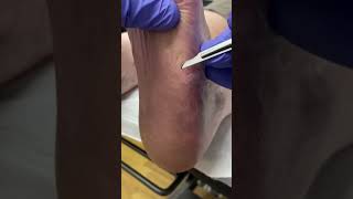 Ditch the corn smooth the callus Follow this Aussie podiatrists expert removal guide [upl. by Reivazx845]