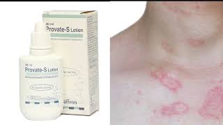 Allergy Eczematreatment in urduProvate S lotion Uses benefits and disadvanteges in urdu [upl. by Rozamond924]