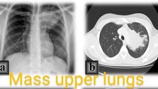 ct scan chest plain  soft tissue mass left lung upper and lover lobs  DD pleural based mass lesion [upl. by Jehial]