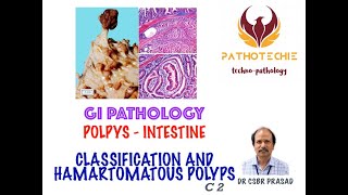 Intestinal Polyps  Classification and Hamartomatous Polyps [upl. by Quitt]