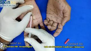 Botox Therapy for Palmer Hyperhidrosis Sweaty Hands  Skinaa Clinic Jaipur [upl. by Middleton]