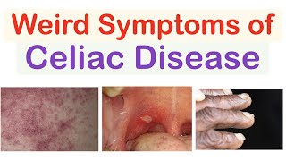 Weird Symptoms of Celiac Disease  Atypical Clinical Features [upl. by Petunia719]