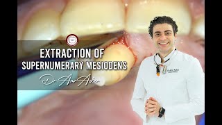 Extraction of supernumerary mesiodens in orthodontics [upl. by Aicatan198]