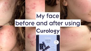 My face before and after using CUROLOGY  honest review NOT SPONSORED [upl. by Carilyn]