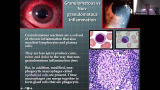 Lecture Granulomatous Disease in an Eye Practice [upl. by Pavel]