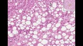 Histopathology Liver Fatty change [upl. by Euginimod]