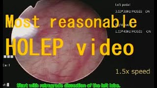 Retroanterograde enbloc HOLEP Commentary video The most reasonable HOLEP method [upl. by Adolph]