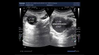 Ultrasound Video showing difference between functional ovarian cyst and Hemorrhagic Ovarian Cyst [upl. by Htnnek781]