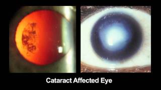 CATRA Cataract Maps with Snapon Eyepiece for Mobile Phones [upl. by Sopher]