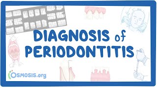 Diagnosis of Periodontitis [upl. by Fey]