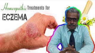 Eczema Dermatitis Treatment in Homeopathy by Dr PS Tiwari [upl. by Nnaytsirk101]