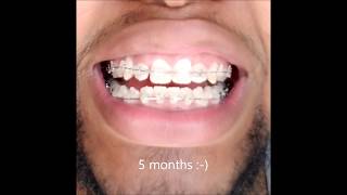 Braces 6 Month Timelapse [upl. by Ymmit]