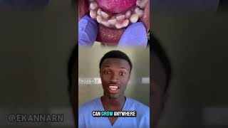 Hyperdontia is a condition where a person has extra teeth known as supernumerary teeth hyperdontia [upl. by Dorelia825]