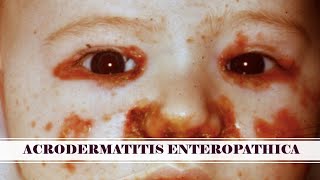 Acrodermatitis Enteropathica  Unraveling Symptoms Investigating Causes And Pioneering Treatment [upl. by Yorke172]